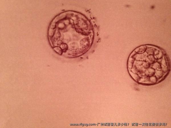 廣州試管嬰兒多少錢？ 試管一次性花費(fèi)很多嗎？