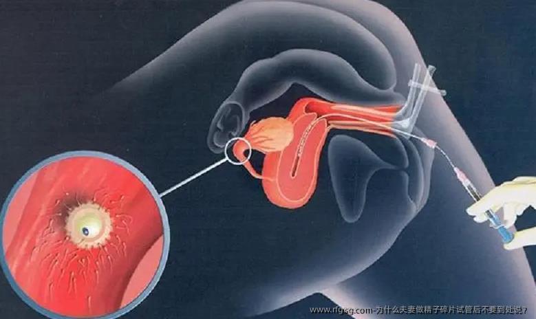 為什么夫妻做精子碎片試管后不要到處說(shuō)？