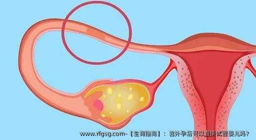 【生育指南】：宮外孕后可以直接試管嬰兒嗎？